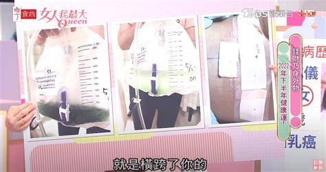 乳暈 黑點